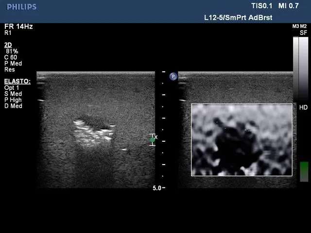 Biopsy and Elastography Ultrasound Training Model