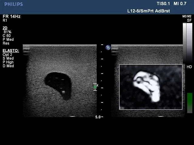 Biopsy and Elastography Ultrasound Training Model
