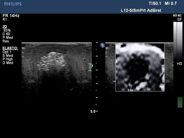 Biopsy and Elastography Ultrasound Training Model