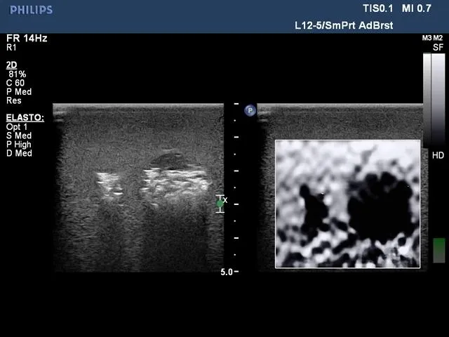 Biopsy and Elastography Ultrasound Training Model