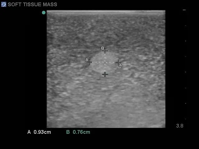 Biopsy and Elastography Ultrasound Training Model