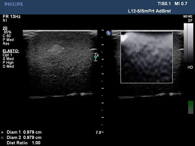 Biopsy and Elastography Ultrasound Training Model
