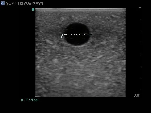 Biopsy and Elastography Ultrasound Training Model