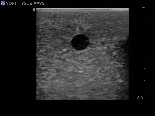 Biopsy and Elastography Ultrasound Training Model