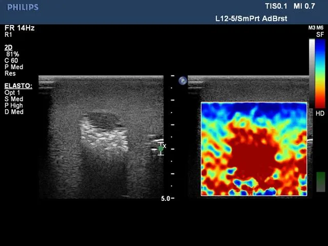 Biopsy and Elastography Ultrasound Training Model