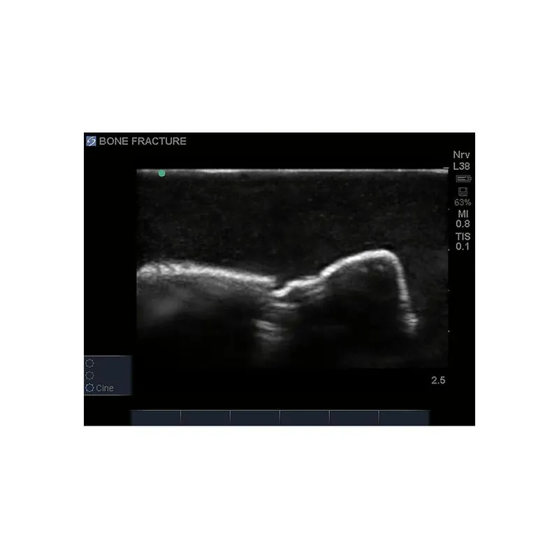 Bone Fracture Ultrasound Training Block, Crepitus Fracture