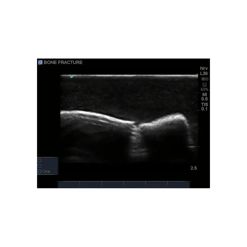 Bone Fracture Ultrasound Training Block, Crepitus Fracture