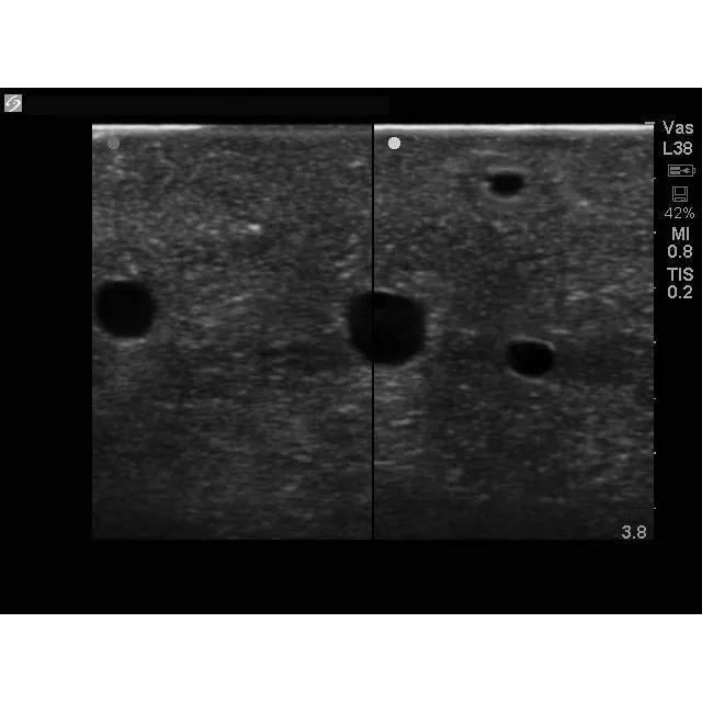 Branched 4 Vessel Ultrasound Training Block