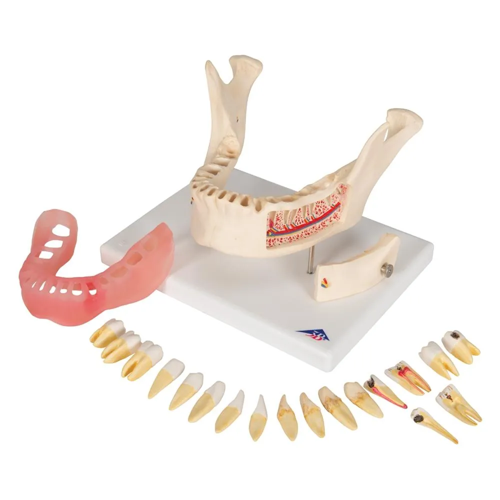 Dental Disease Model, 2x magnified, 21 parts