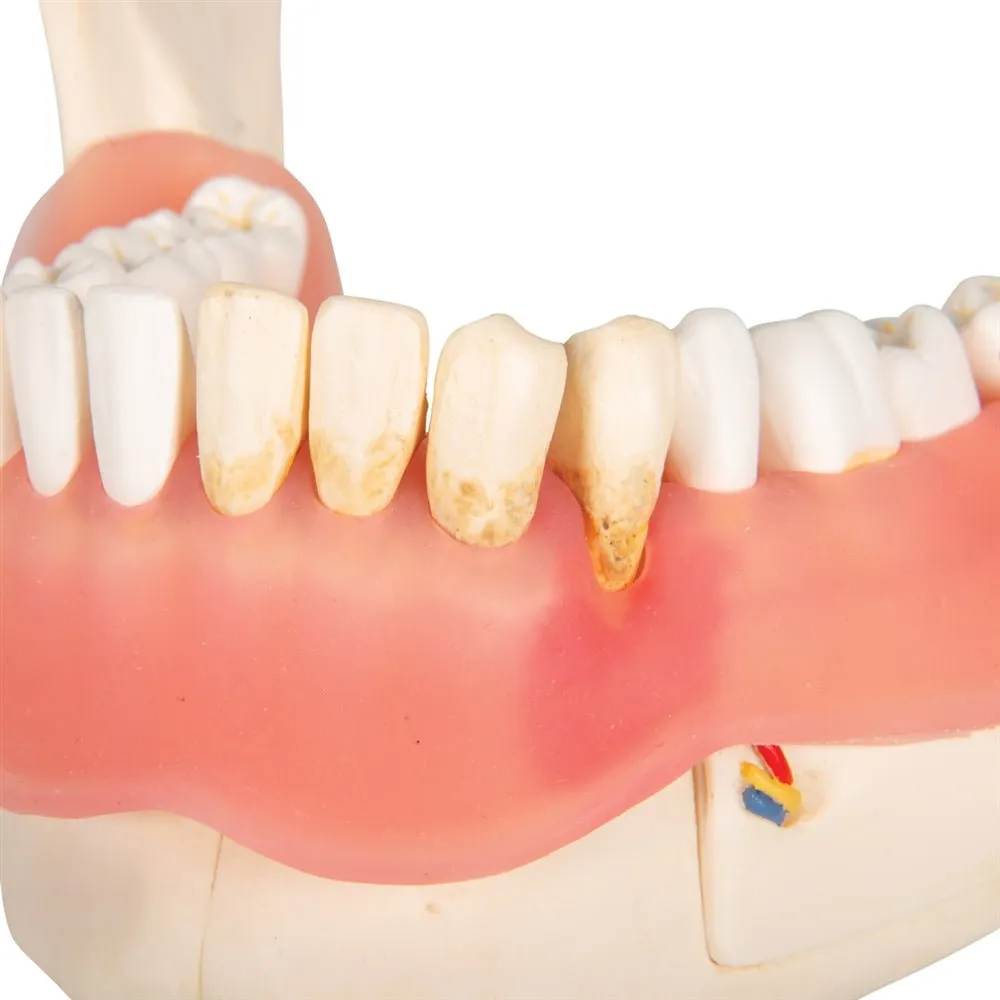 Dental Disease Model, 2x magnified, 21 parts