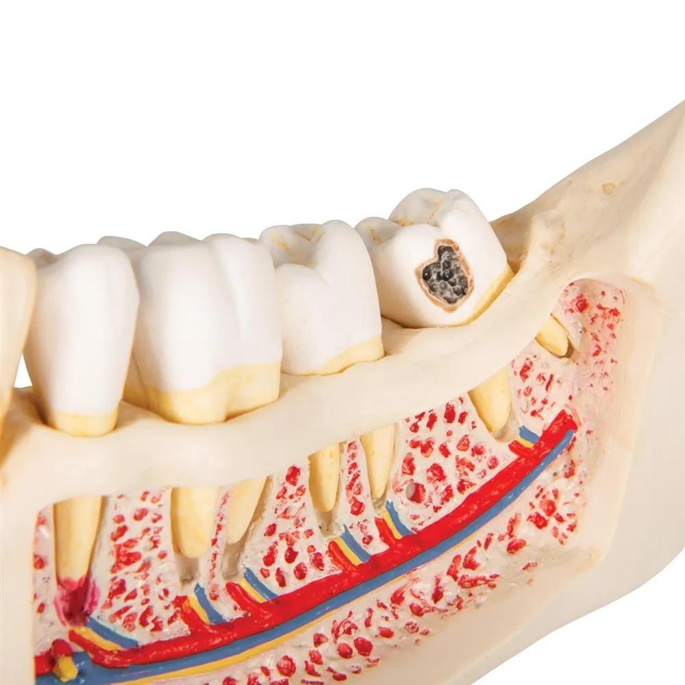 Dental Disease Model, 2x magnified, 21 parts