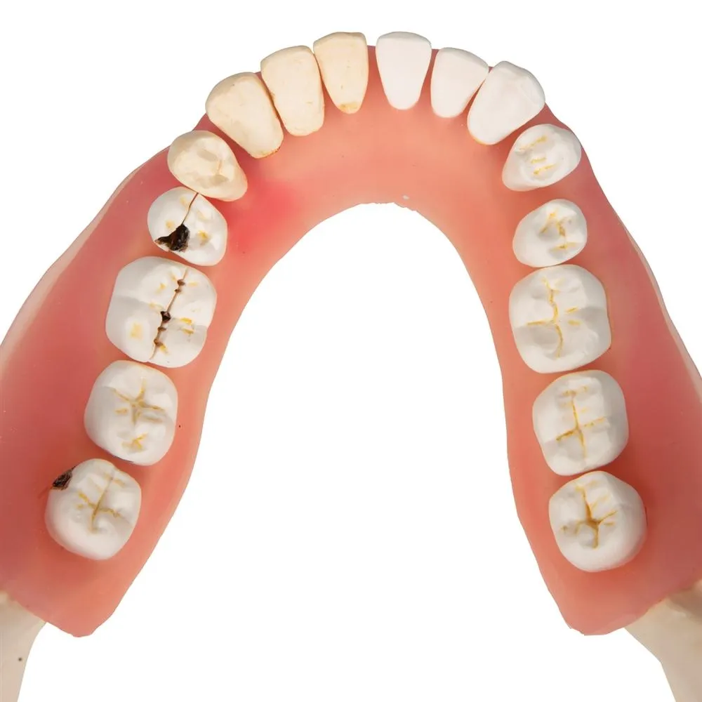 Dental Disease Model, 2x magnified, 21 parts