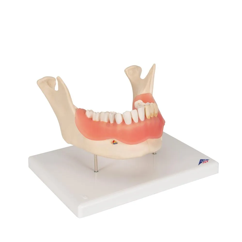 Dental Disease Model, 2x magnified, 21 parts