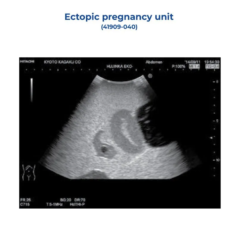 Ectopic Pregnancy Unit