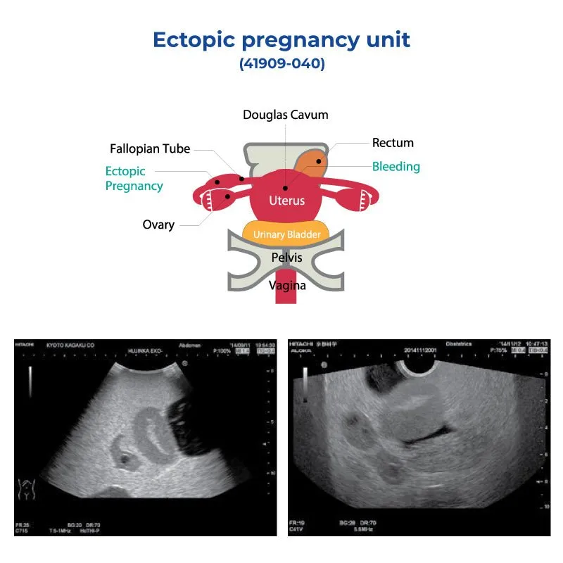 Ectopic Pregnancy Unit