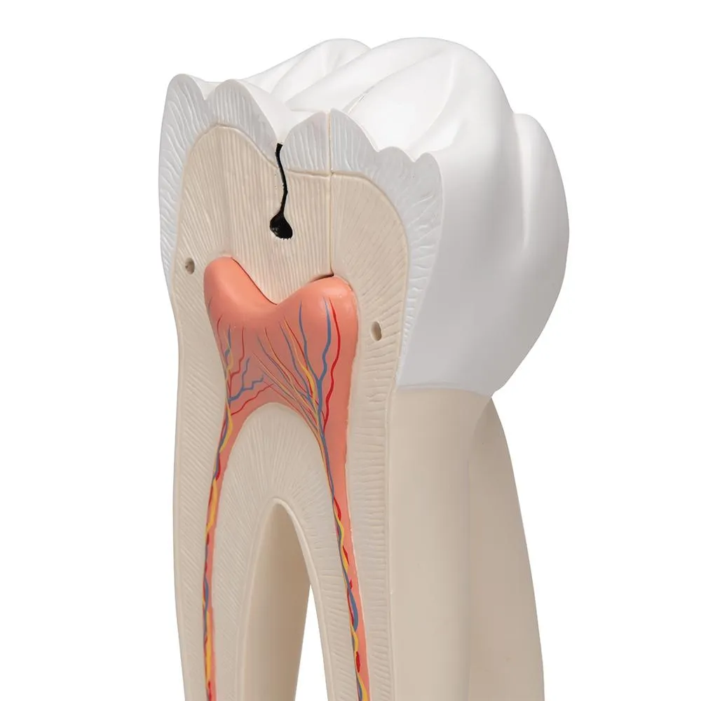 Giant Molar with Cavities, 15x life size, 5 part