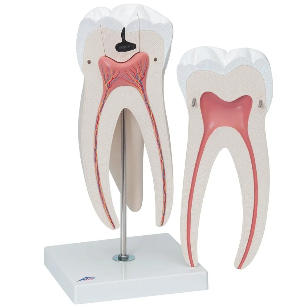 Giant Molar with Cavities, 15x life size, 5 part