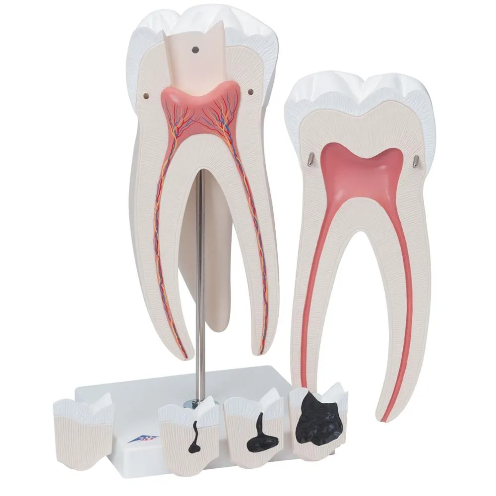 Giant Molar with Cavities, 15x life size, 5 part