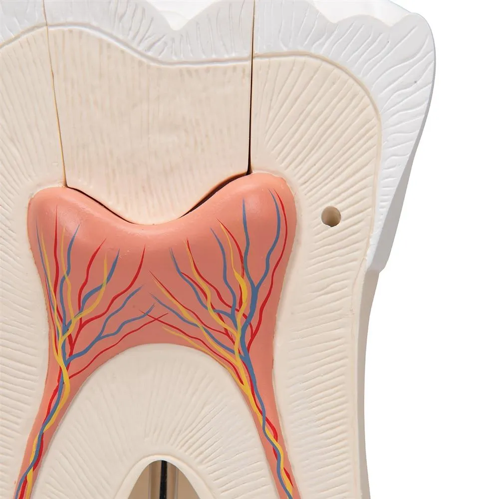 Giant Molar with Cavities, 15x life size, 5 part