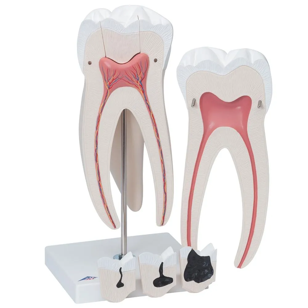 Giant Molar with Cavities, 15x life size, 5 part