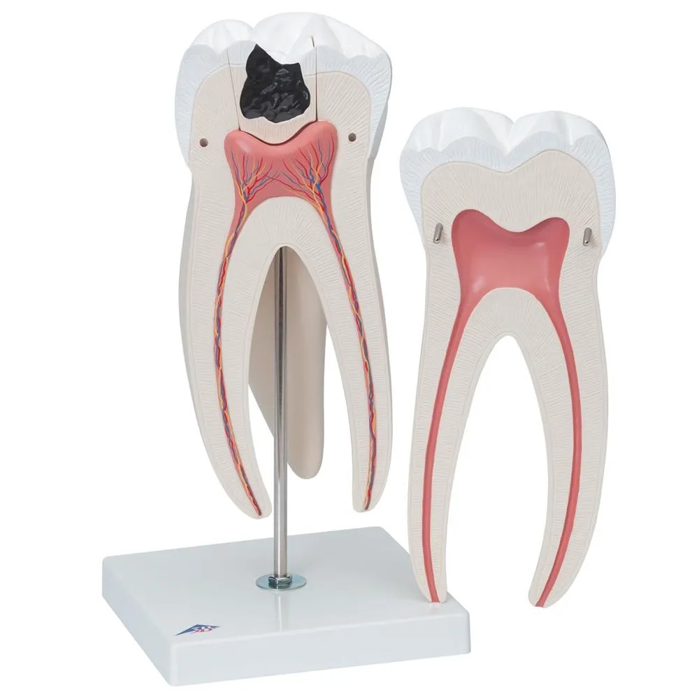 Giant Molar with Cavities, 15x life size, 5 part