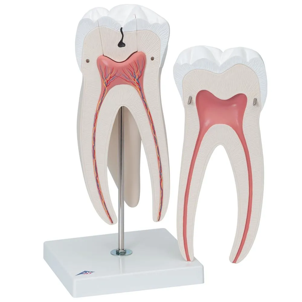 Giant Molar with Cavities, 15x life size, 5 part