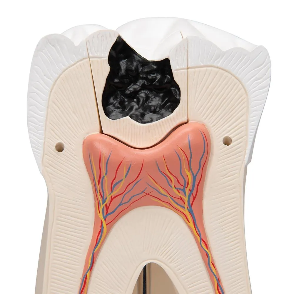 Giant Molar with Cavities, 15x life size, 5 part