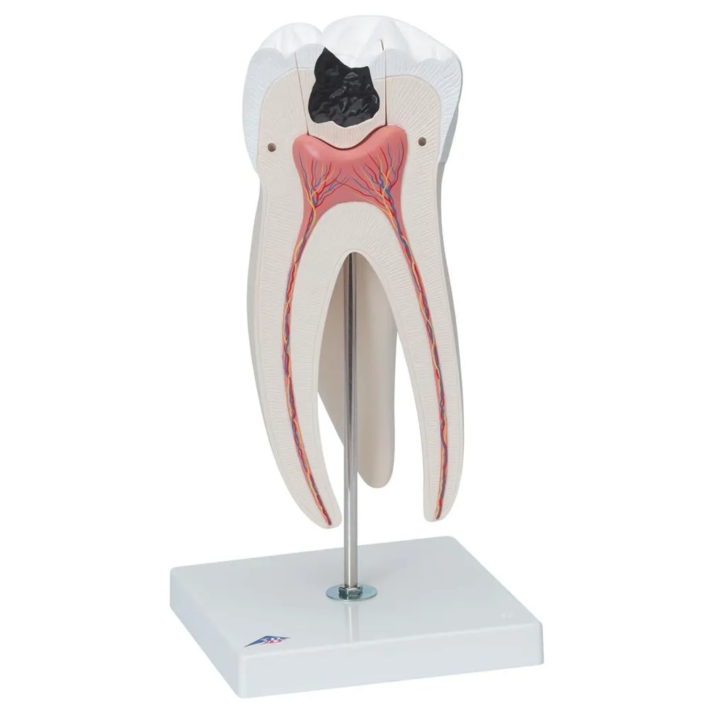 Giant Molar with Cavities, 15x life size, 5 part