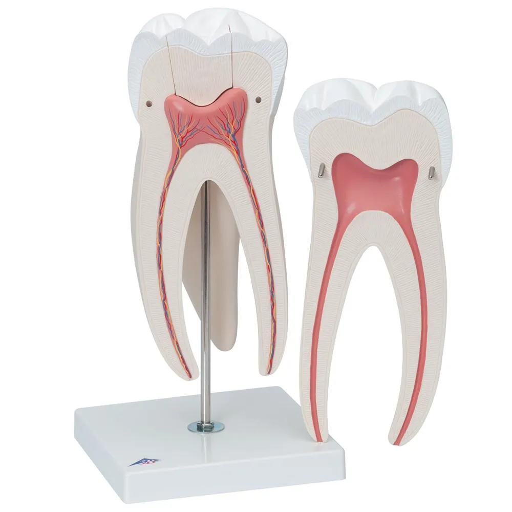 Giant Molar with Cavities, 15x life size, 5 part