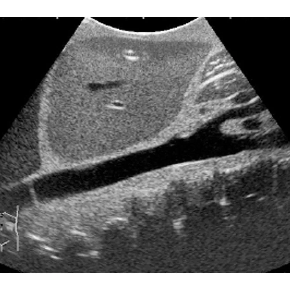Ultrasound Exam 'ECHOZY' without Pathologies