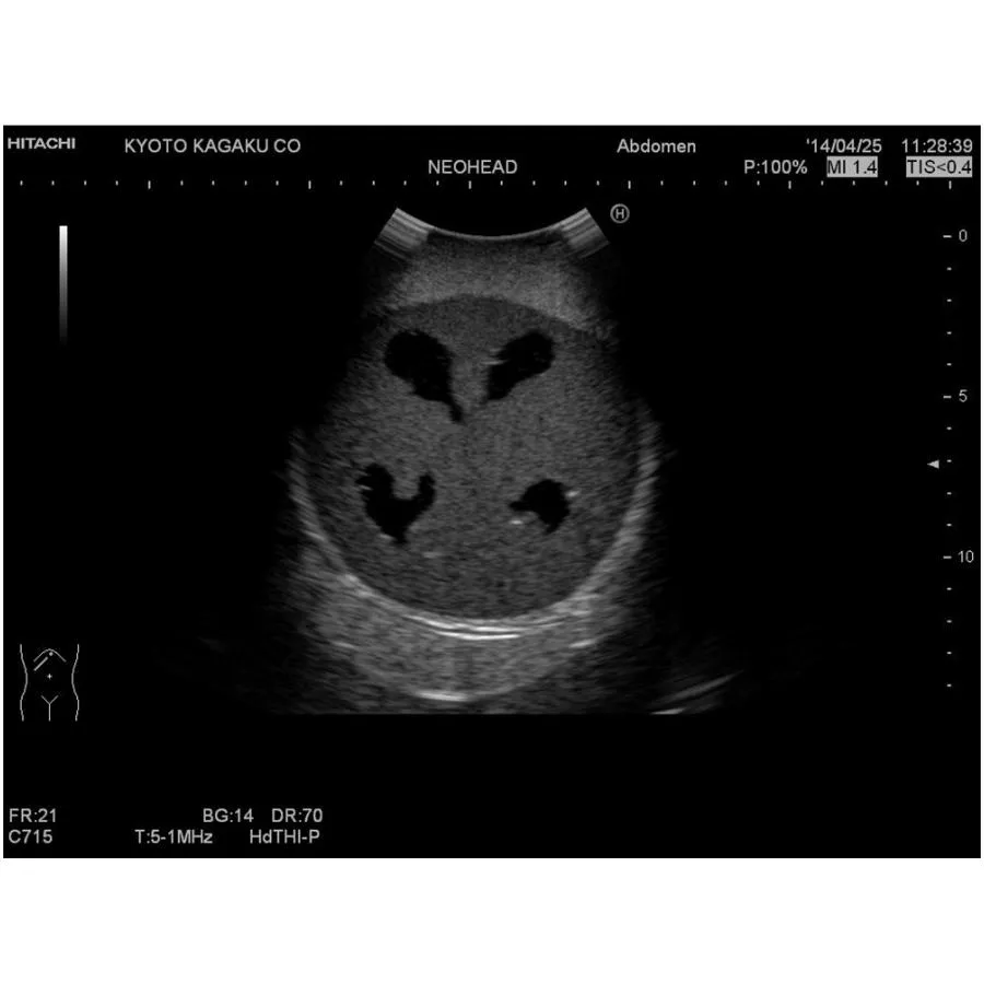 Ultrasound Neonatal Head Phantom, Abnormal Type