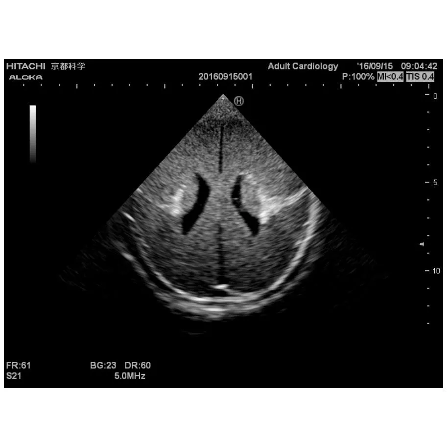 Ultrasound Neonatal Head Phantom, Normal type