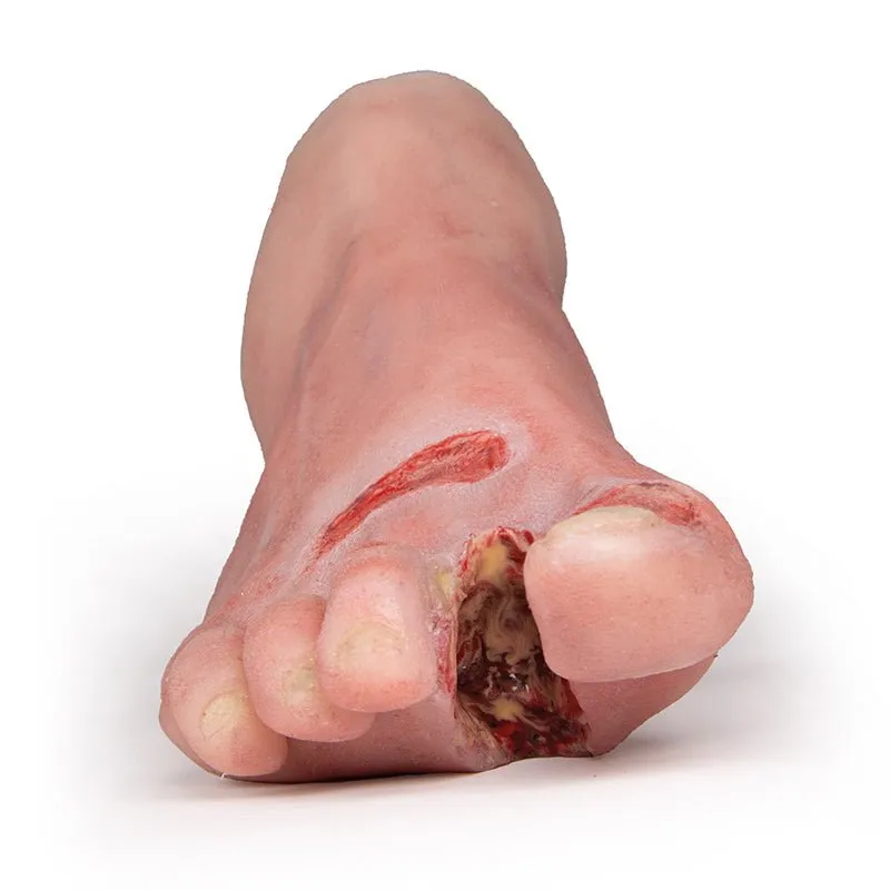 Wound Foot with Diabetic Foot Syndrome, Severe Stage
