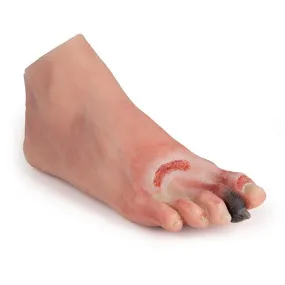 Wound Foot With Diabetic Foot Syndrome