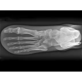 X-Ray Phantom Foot, Opaque