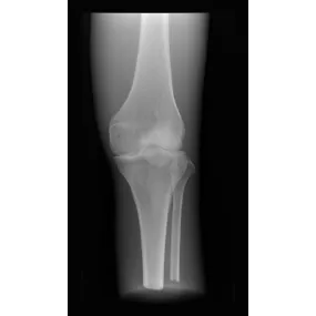 X-Ray Phantom Knee, Opaque